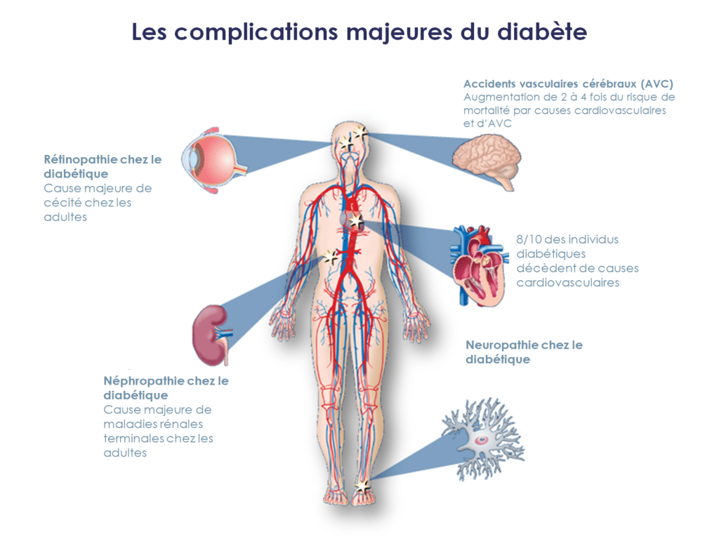 Les complications majeures du diabète