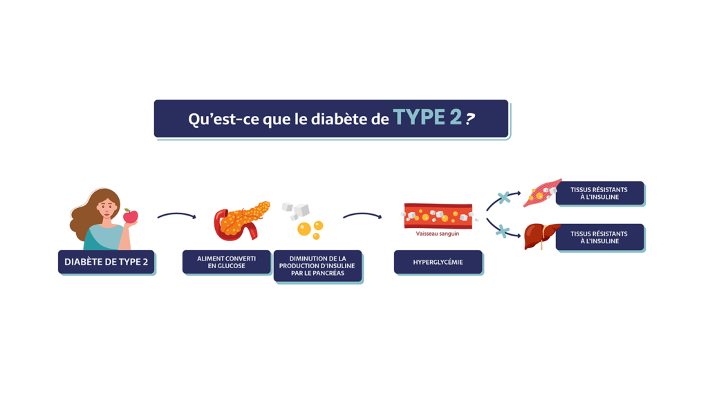 Qu’est-ce que le diabète de type 2 ?